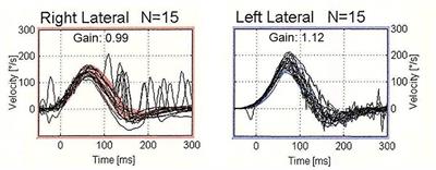 Presence of corrective saccades in patients with normal vestibulo-ocular reflex gain in video head impulse test